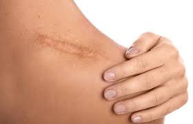 Are there any side effects to using bio oil? Bio Oil Review And Benefits How To Use Bio Oil For Stretch Marks