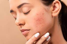 Acne Scars: What's the Best Treatment for You?