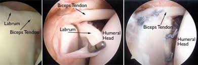 Image result for SLAP Lesion