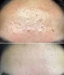 How To Get Rid Of Forehead Acne According To Reddit Ance Treatments