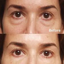 Ophthalmologist Rochester Ny Eye Surgeon Envision Eye Aesthetics Facial Fillers Restylane Under Eyes Under Eye Fillers
