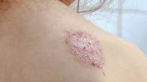 Image result for Eczema nummulare
