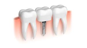 Also, you can contact them and discuss with them which plan suits you best. Dental Implants Tooth Implant In Turkey Mcan Health