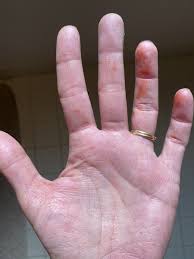 Orange brown spots on hands. Page 2 What Are These Orange Stains That Have Appeared On My Hands Overnight Gransnet