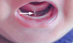 Image result for Ankyloglossia