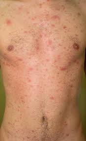 Infection à mycoplasmes solution naturelle