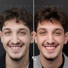 🇽🇰🇦🇱 Faseta (Veneers) nga E.max duke e ruajtur maksimalisht strukturën  e dhëmbëve! 🇺🇸 Gingivectomy and E.max Veneers done via minimal  preparation