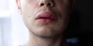 Image result for Lip Cancer