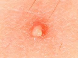 Traditional treatments have resulted in pain and scarring, but molluscumrx offers a molluscum treatment over the counter. Molluscum Contagiosum Symptoms Causes And Treatment
