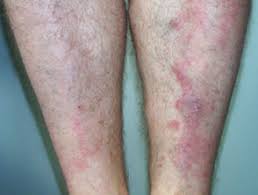 Lichen planus symptoms, causes and treatment lichen planus is an inflammatory skin condition in which flat lesions show up on the skin or mucous layer, causing pain, redness and tingling. Lichen Planus Images Dermnet Nz