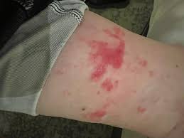 Image result for allergy rash on the legs