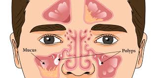 Image result for Rhinosinusitis