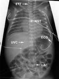 Neonatal Lines Tubes And Catheters Wikiradiography Pediatric Nurse Practitioner Nicu Nurse Pediatric Nursing