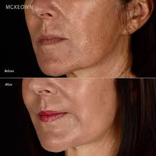 Image result for Laser Skin Procedure