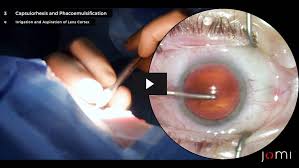 Image result for Cataract Extraction