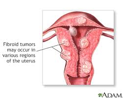 Indigestion, heartburn or symptoms similar to an ulcer may be signs of a stomach tumor. Abdominal Mass Information Mount Sinai New York