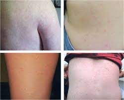 Mri and other imaging scans can also help detect inflammation and brain swelling. West Nile Virus Skin Rashes