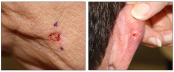 Completing treatment can be both stressful and exciting. Genetics Of Skin Cancer Pdq Health Professional Version National Cancer Institute