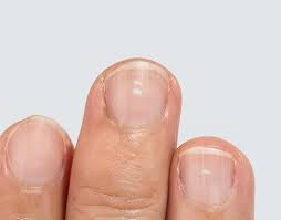 Medically this is known as subungual hematoma. Nail Discoloration What To Do When To Worry University Of Utah Health