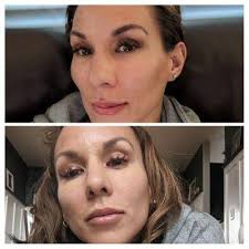 Pretty Flawless Aesthetics, 8770 E Arapahoe Rd, Ste 203, Centennial, CO  80112, US