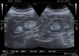 Renal Duplication Ultrasound Findings Increase In Renal Length Two Distinct Collecting Systems Superior S Medical Ultrasound Radiology Ultrasound Sonography