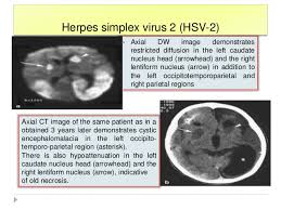 mri findings of herpes simplex encephalitis. Imaging Of Viral Encephalitis