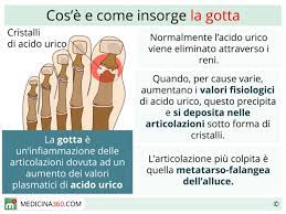Evitare al massimo gli alimenti citati durante il trattamento della gotta è determinante per ridurne e superarne i sintomi. Gotta Sintomi Cause Dieta E Rimedi Per La Malattia