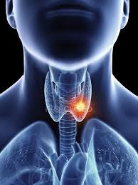 Symptoms predominantly include a sore that does not heal or a change in the voice. Illustration Of Throat Cancer In Male Body Silhouette Close Up Biological System Stock Photo 236859720