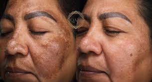 Image result for Melasma