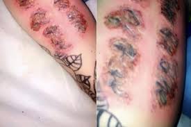 Pictures Of Grotesquely Infected Tattoos Lovetoknow