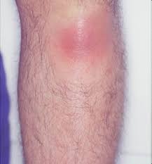 Image result for erythema nodosum