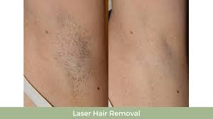 Dohner can do a test on a small area so you can experience what the laser treatment. Laser Hair Reduction Lasersense