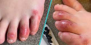 We did not find results for: What Are Covid Toes Doctors Explain The New Coronavirus Symptom