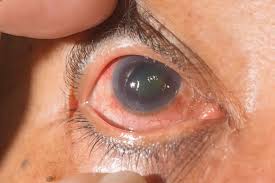 Image result for Glaucoma