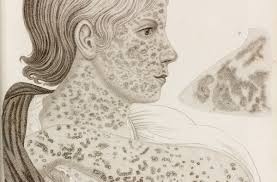 Image result for measles