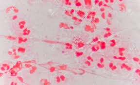 Learn about term:double+cocci = diplococci with free interactive flashcards. Moderate Red White Blood Cells With Gram Negative Diplococci Stock Photo Picture And Royalty Free Image Image 77751785