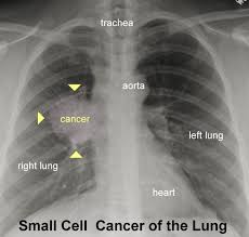 Image result for lung cancer xray