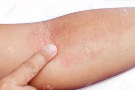 Adults usually develop heat rash in skin folds and where clothing causes friction. Close Up Of An Women S Inner Forearm Arm Infested With Rash Stock Photo Picture And Royalty Free Image Image 140321660