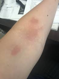 Bacteria invade the skin through the wound and rapidly spread outward from the site of entry. Inner Arm Rash Not Raised Not Itchy Has Spread Slightly But Not Much Over Last Several Days 28 Yo Female Diagnoseme