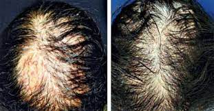 Methotrexate can cause itching, skin rash, dizziness, and hair loss. Scielo Brasil Efficacy And Safety Of Methotrexate In Alopecia Areata Efficacy And Safety Of Methotrexate In Alopecia Areata