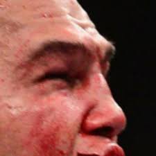 Use an ice pack or an ice cube wrapped in a cloth. Ufc 189 Robbie Lawler S Nsfw Lip Pic Will Make You Gag But Stitched Up Ruthless Insists It Doesn T Hurt Mmamania Com