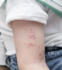 Image result for Varicella zoster on human skin