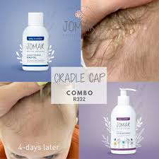 Image result for Cradle Cap