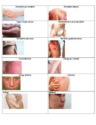 Image result for dermatitis contacta toxica