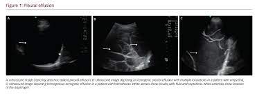 The pleural fluid may loculate between the visceral and parietal pleura (when there is partial fusion of the pleural layers) or within. Practice Pearls For Performing Pleural Ultrasound With Focus On Pleural Effusion And Pleural Thickening Touchrespiratory
