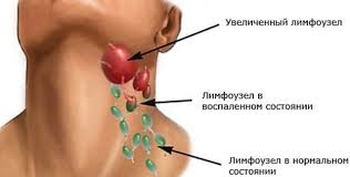 Opuhli Limfouzly Na Shee Chto Delat Kak Lechit Gorodskaya Klinicheskaya Bolnica 1