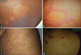 Borderline borderline leprosy is a rare unstable form of leprosy defined by: Revisiting Hansen S Disease Recognizing The Many Neurodermatologic Faces And Its Diagnostic Challenges Shelley Bp Shenoy Mm Arch Med Health Sci