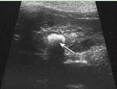 Maybe you would like to learn more about one of these? Dokter Hewan V Twitter Contoh Hasil Usg Fus Seperti Ini Pada Tanda Panah Adalah Batu Ginjal Yang Berada Di Kandung Kemih Http T Co Lnreusex6m