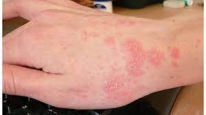 Image result for mite bites on humans