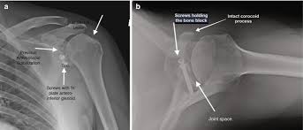 Image result for Shoulder Imaging